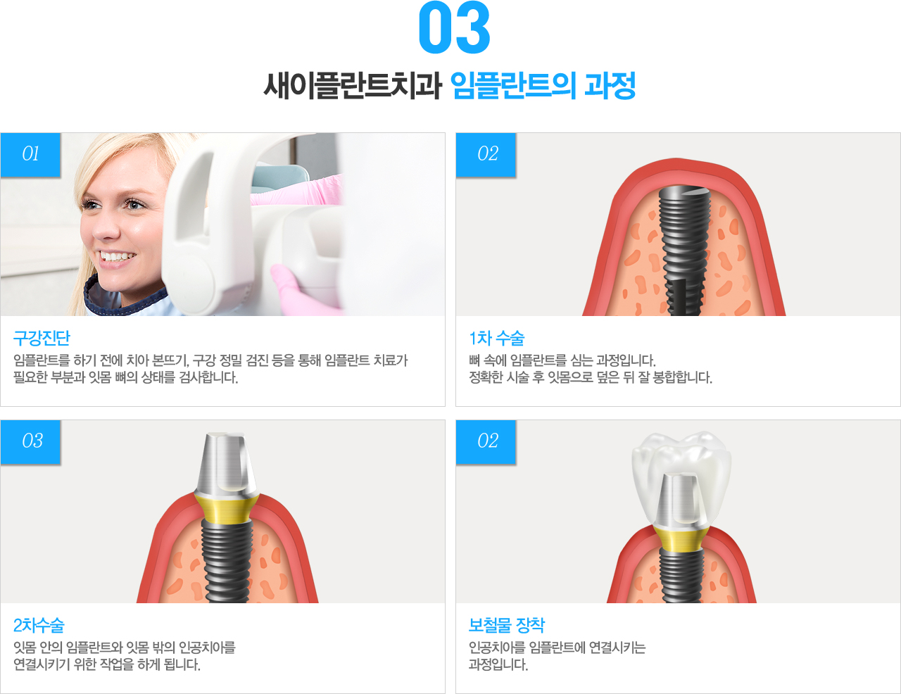 1. ˻
öƮ ü  öƮ ϰ  ڸ ո ¿ ڸ   ڼ ˻縦 մϴ. ˻δ , panorama X-ray, standard X-ray     ľؾ մϴ.
索 Ȥ 缱 ġ  ް ִٸ  ǻ   ġḦ ϰ ˴ϴ. 2. 1 
 ӿ öƮ ɴ Դϴ. Ȯ ü  ո    մϴ. öƮ λ ٱ ɸ Ⱓ  Ʒ  3~4,   5~6  Դϴ. 

3. 2 
 2  öƮ       ո  öƮ ո  ΰġƸ Ű  ۾ ϰ ˴ϴ. 

4. ö 
 ΰġƸ öƮ Ű Դϴ. öƮ    ȮεǸ   ڽſ ° ۵ ΰġƸ ŵϴ.